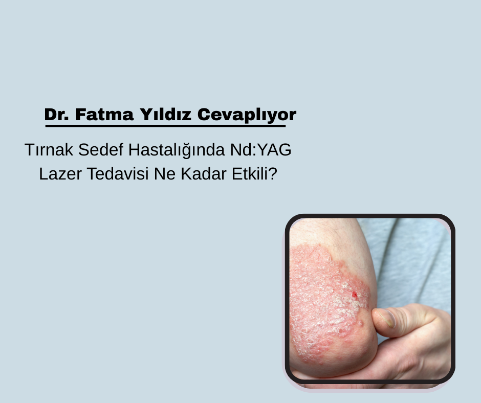 Tırnak Sedef Hastalığında Nd:YAG Lazer Tedavisi Ne Kadar Etkili?