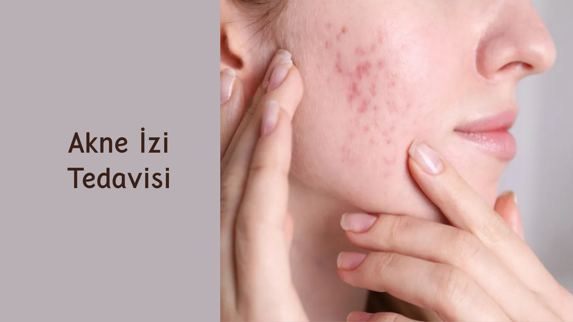 Akne İzi Tedavisi