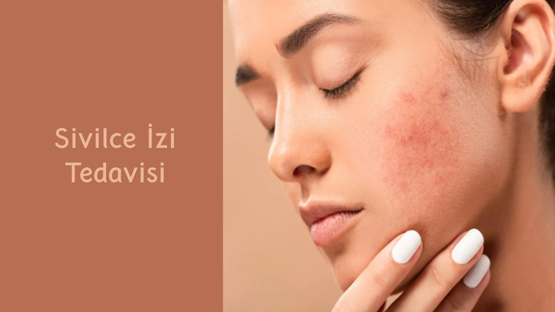 sivilce-izi-tedavisi