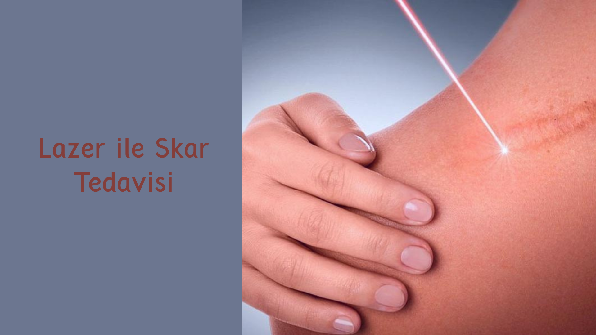 ankara lazer ile skar tedavisi