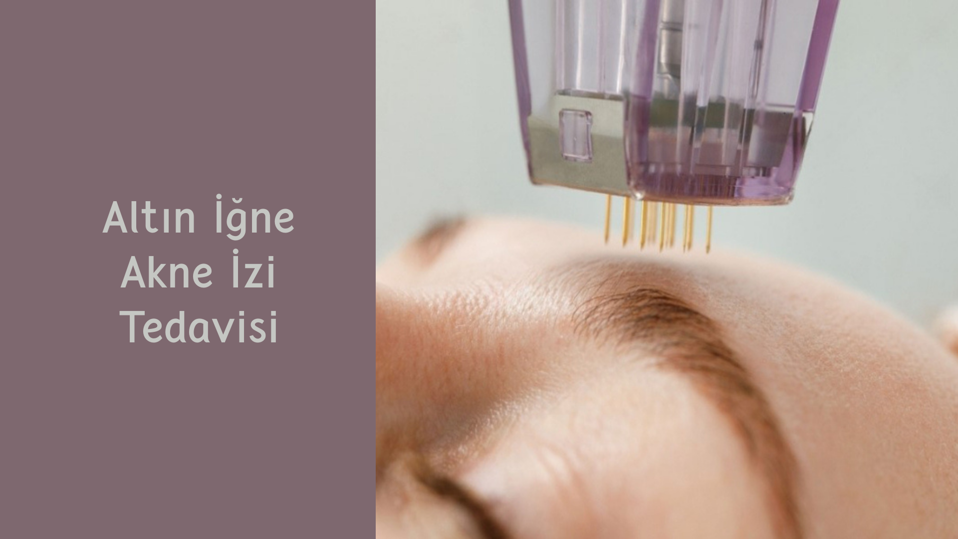 ankara altin igne akne izi tedavisi