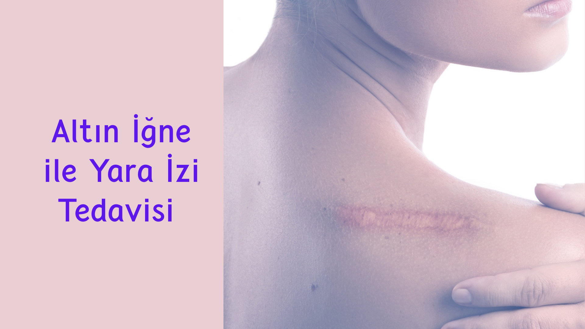 ankara altin igne ile yara izi tedavisi