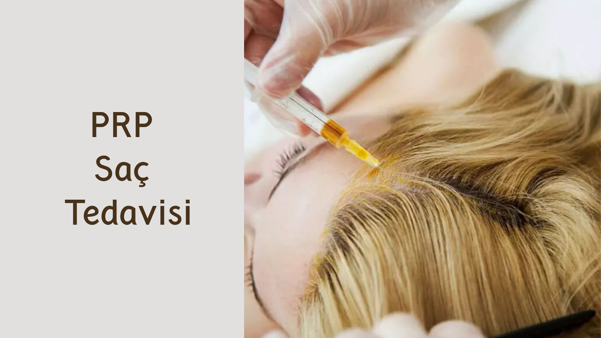 ankara prp sac tedavisi