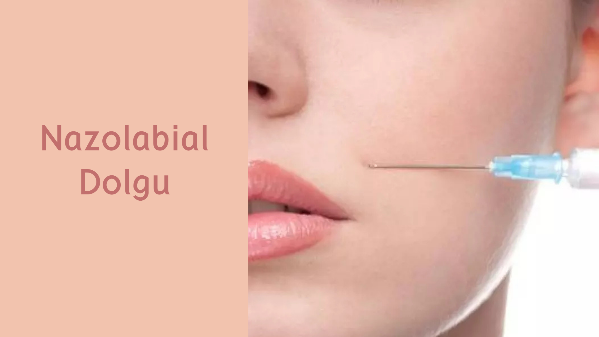 ankara nazolabial dolgu